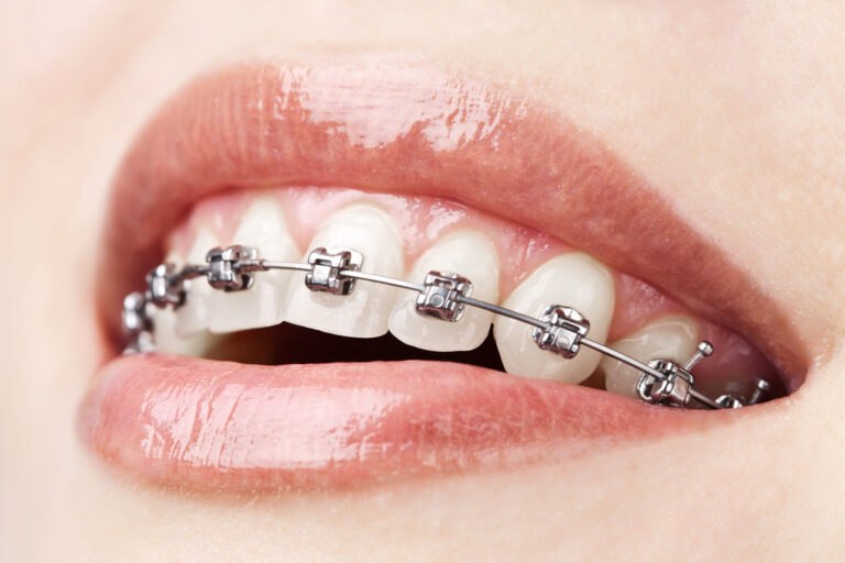 braces on teeth