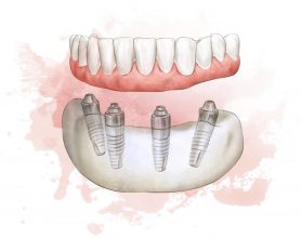 Full Arch dental implant sketch