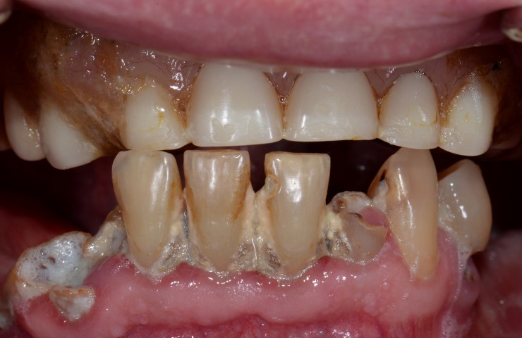 Dental Implants - Before