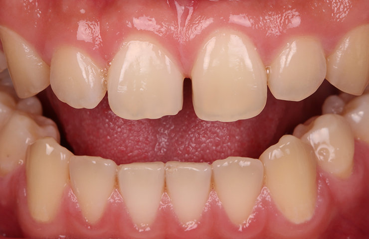 Teeth Gap Uneven Teeth Before Veneers Perth